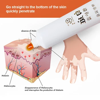 2 ks Vitiligo Masť Vitiligo Leukoplakia Liečba Masť Čínsky Herebal Pigment White Spot Repair Cream Skin CareP1159
