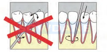 6Pcs Zubné Výťah Bean Výťah Ústne Zub Uvoľnenie Root Extraction Kit Zubný Implantát Minimálne Invazívne bez rámčeka