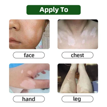 Biela Škvrna Liečbu Ochorení Masť Leukoplakia Ochorenia Repair Cream Vitiligo Čínskej Lekárskej Pigment, Melanín, Starostlivosť O Pleť, Balzam