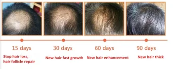 Dimollaure Rast Vlasov (anti Hair Loss Liquid 10 ml husté vlasy rýchlo sunburst rast vlasov rásť alopécia Liečba olej podstate
