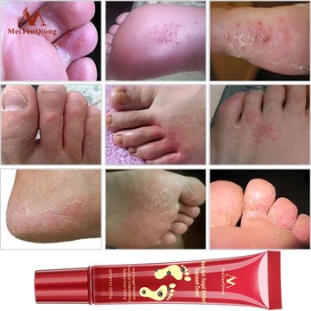 Meiyanqiong Starostlivosť o Nohy Krém na Nohy spa Pedikúra Bylinné Detox Proti Plesňové Infekcie Onychomycosis Huba Liečba Pre nohy 15 g