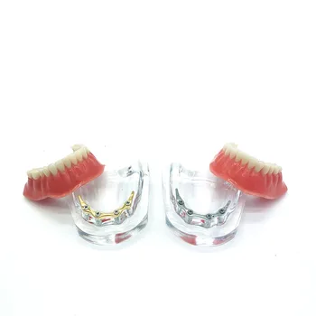 Oprava zubov implantát model s zlatý bar Protézy Zuby mandibular model Zubné Model Vyučovania