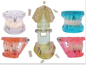 Zubné Zuby Model Obnovy Zubný Implantát Model Jasné, Transparentné farby Nemocnici na Klinike, Zubár Potrieb, Modelov, Laboratórne Štúdie