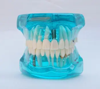 Zubné Zuby Model Obnovy Zubný Implantát Model Jasné, Transparentné farby Nemocnici na Klinike, Zubár Potrieb, Modelov, Laboratórne Štúdie