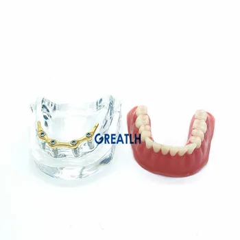 Zuby mandibular implantát model Opravu zubov implantát model zubných náhrad Zubnými Model Vyučovania